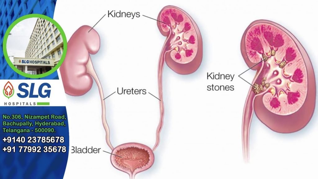 Listen to the informative talk of Dr. Vijay Varma, Renal Specialist, SLG Hospitals