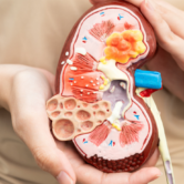 Kidney Stones – How to Manage in 2026